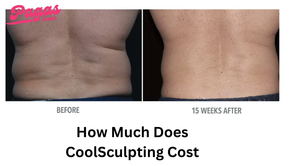 How Much Does CoolSculpting Cost? Shocking Price Revealed!