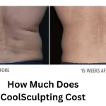 How Much Does CoolSculpting Cost? Shocking Price Revealed!